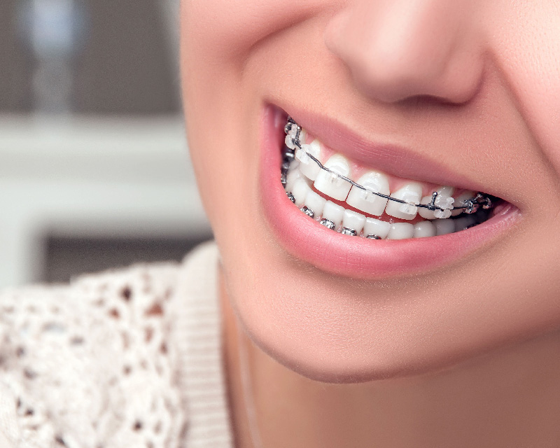 Orthodontics Treatment